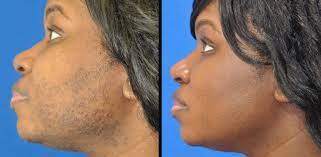 619e6b186fce23dd5a942a74_laser hair removal before and after