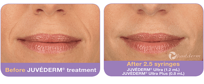 Juvéderm-before-after (1)