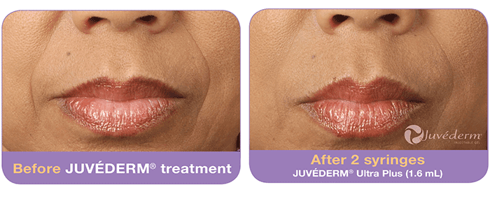 Juvéderm-before-after (3)