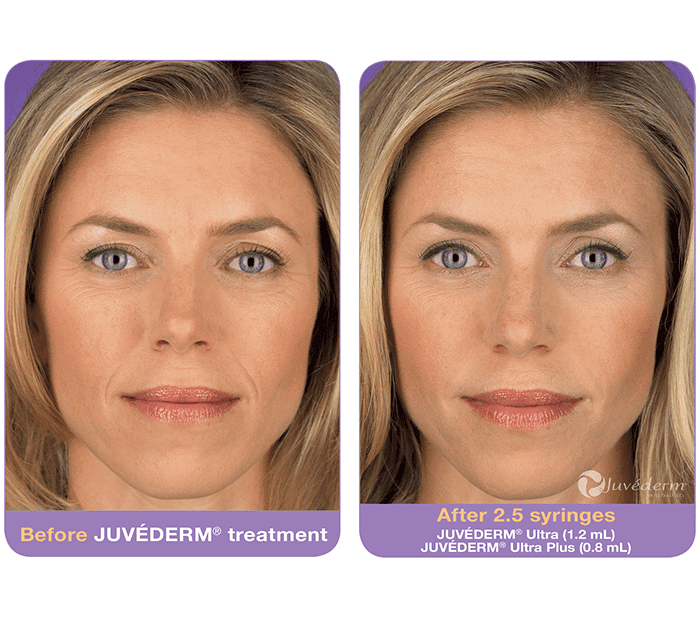 Juvéderm-before-after (5)