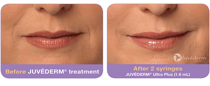 Juvéderm-before-after (6)