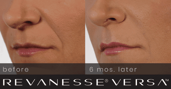 Versa_beforeafter