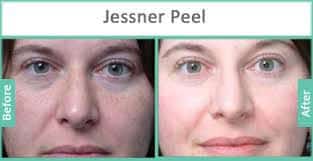 chemical_peel_before_after (1)