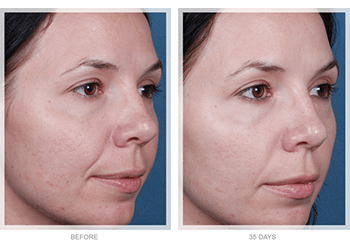 chemical_peel_before_after (1)