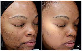 chemical_peel_before_after (2)