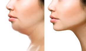 kybella before and after