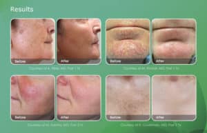 laser resurfacing before and after
