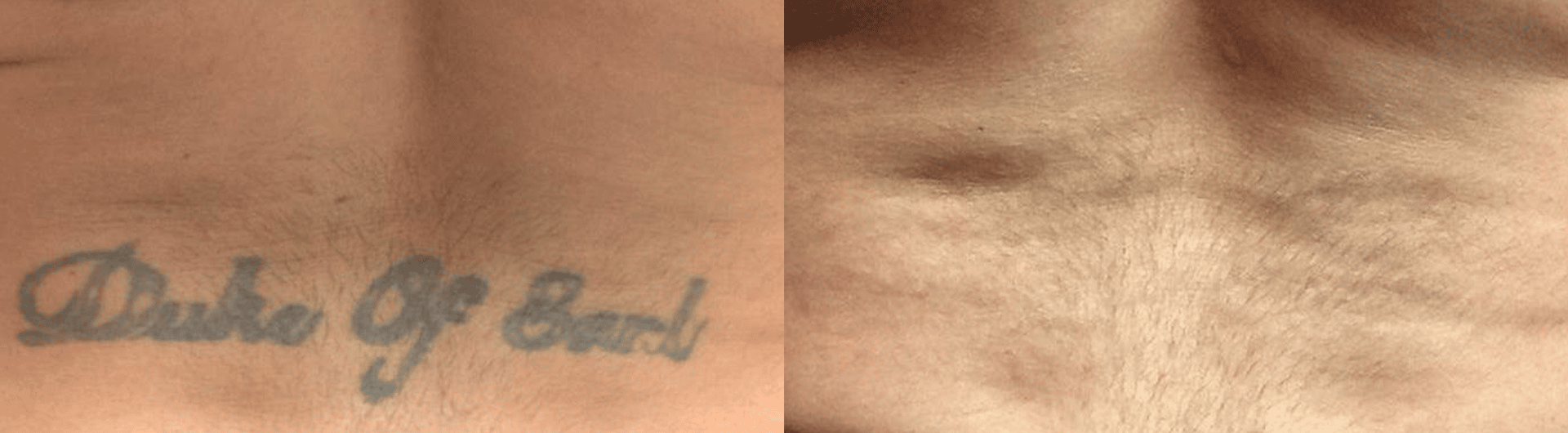 laser tattoo removal before and after 2