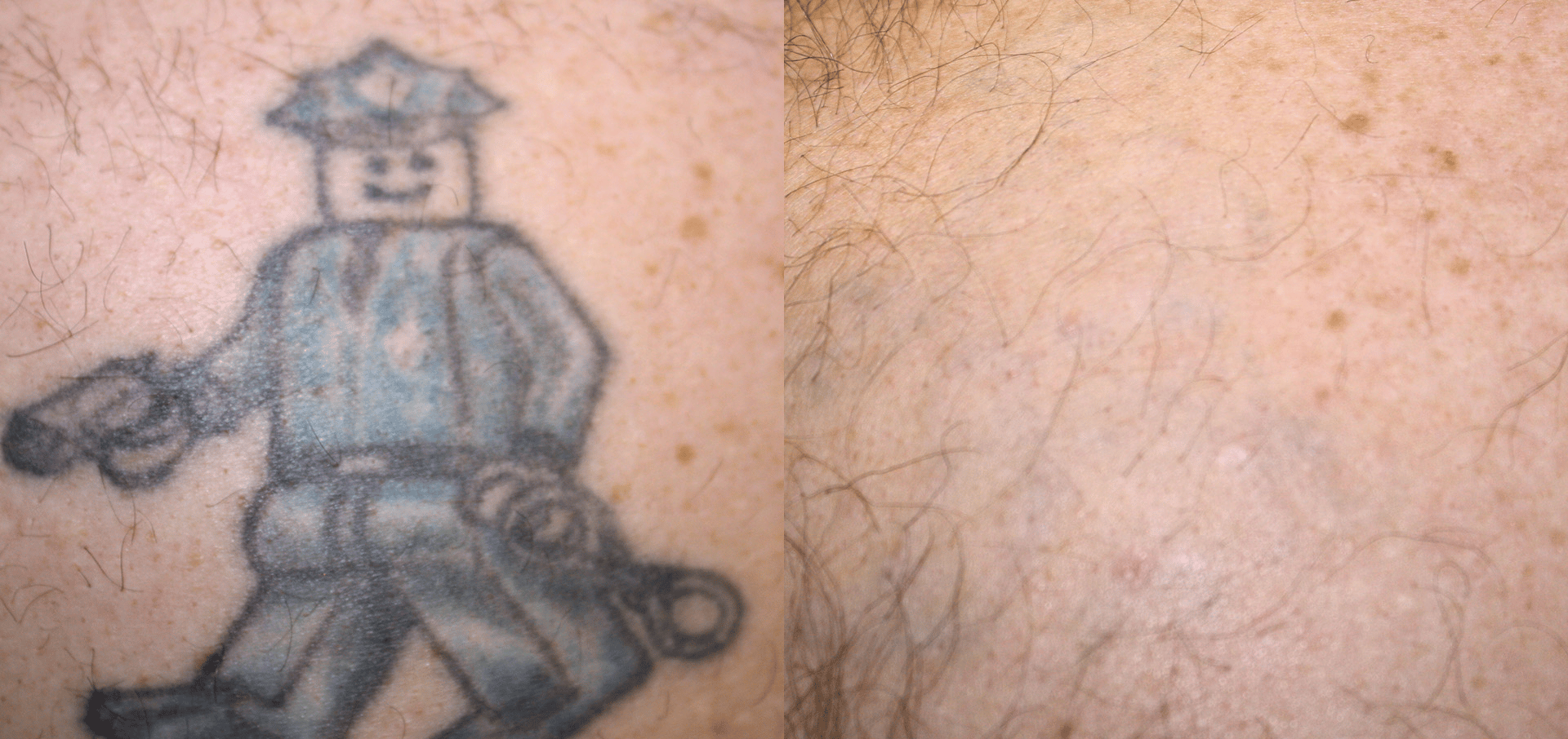 laser tattoo removal before and after 4