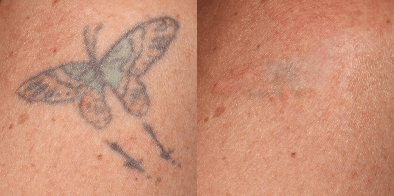 laser tattoo removal before and after 5