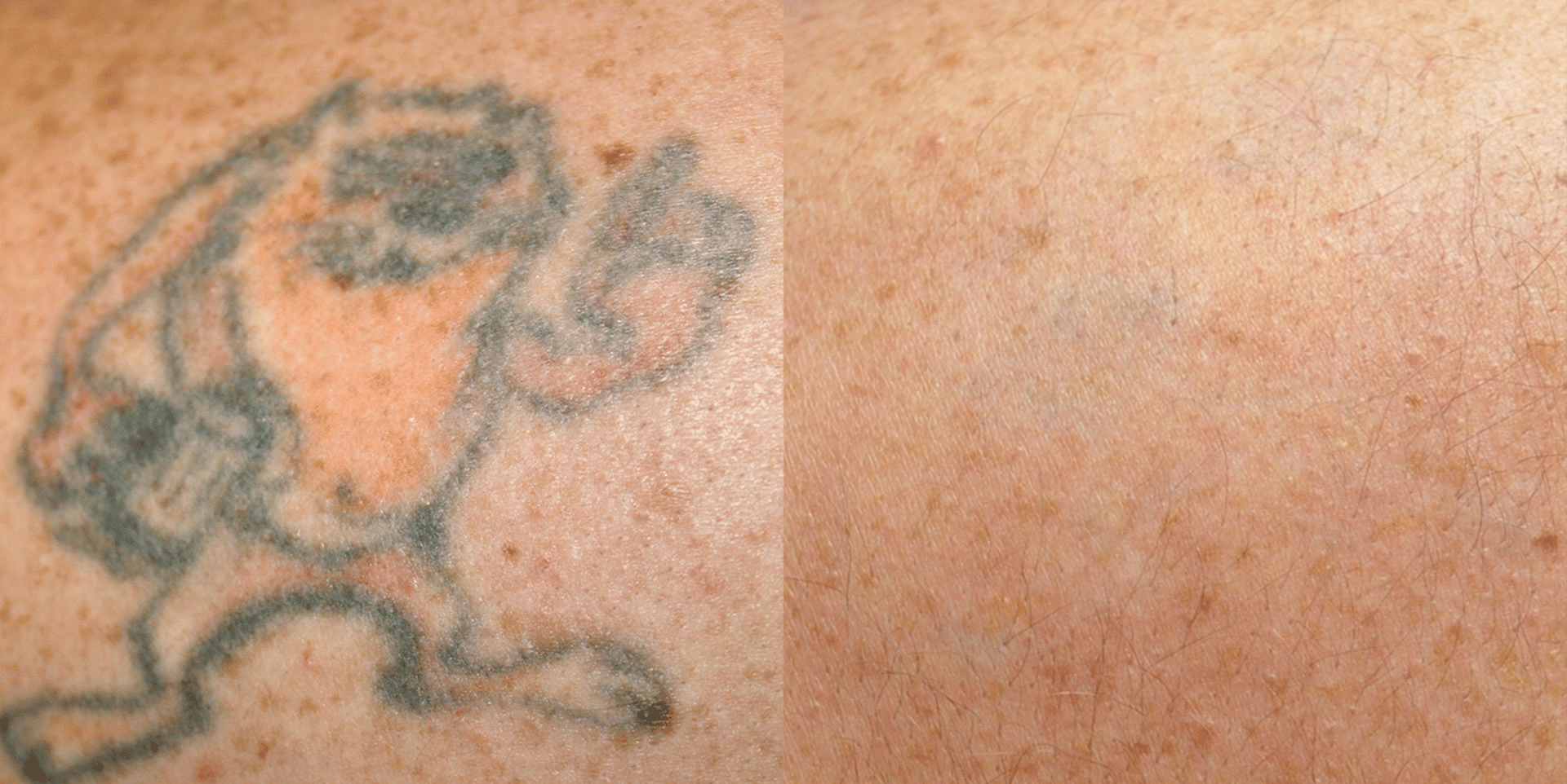 laser tattoo removal before and after 6