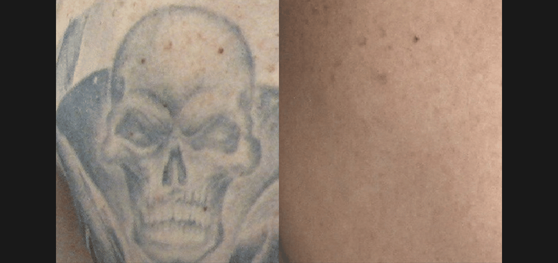 laser tattoo removal before and after 7