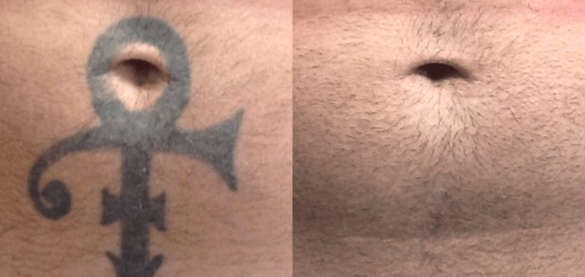 laser tattoo removal before and after 8