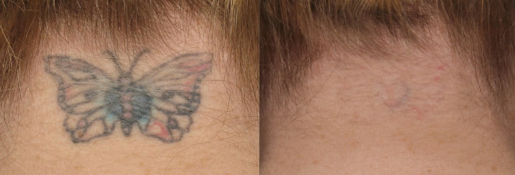 laser tattoo removal before and after 9