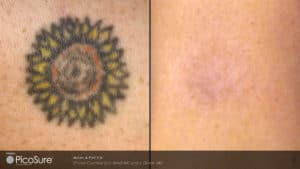 laser tattoo removal before and after