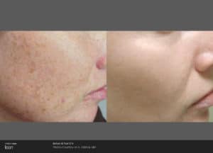 picosure pigmintation before and after 1