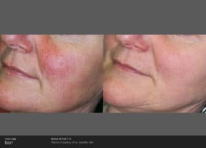 picosure pigmintation before and after 2