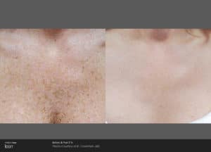 picosure pigmintation before and after 3