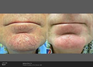 picosure pigmintation before and after