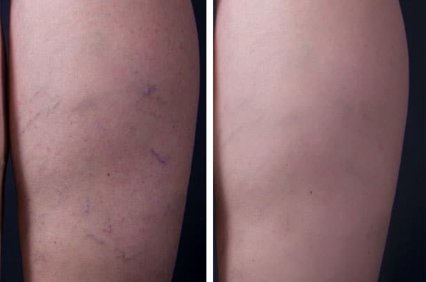 sclerotherapy before and after 1