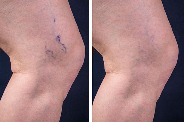 sclerotherapy before and after