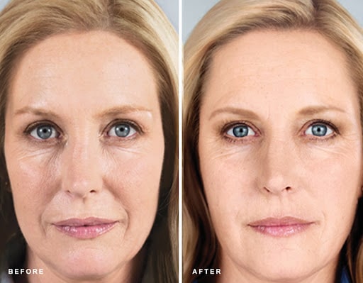 sculptra before and after