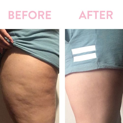 Anti-Cellulite Treatment - Aesthetix Plus Medical Spa