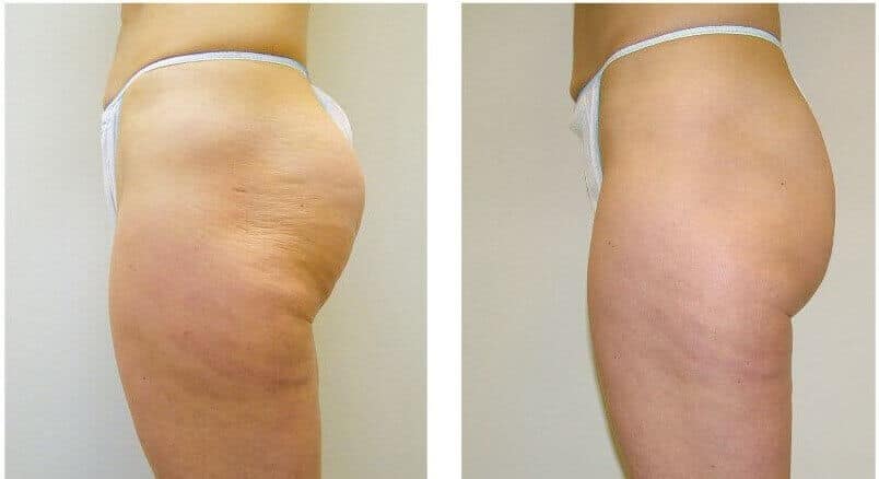 Anti-Cellulite Treatment - Aesthetix Plus Medical Spa