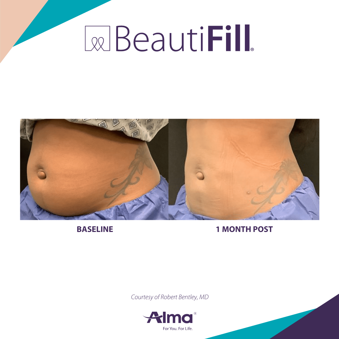 Lipo abdomen